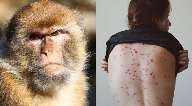 Monkeypox: how it is transmitted, what the symptoms are and what to do to avoid getting infected